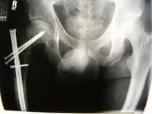 Broke my right hip and femur in a motorcycle accident. Ended up with a full hip replacement. 