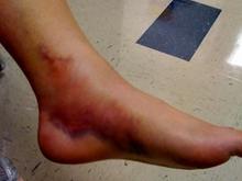 Bike   leg = ouch