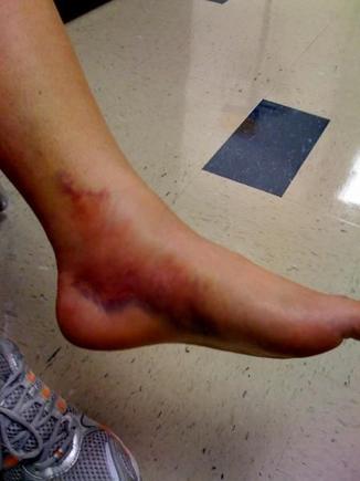 Bike   leg = ouch