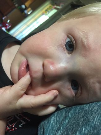 Our 2 and a half year old busted his nose up at the playground Wednesday. Thought it was broken at first. Handled it pretty well for what it was.