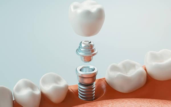 Finest Dental Implants in Fairfield, CT - Dr. Cheung