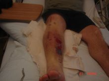 broken leg