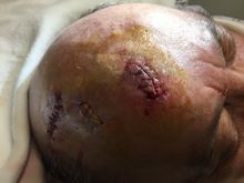 scalp incisions take BIG sutures to close

