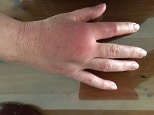 Wasp sting from yesterday’s gardening