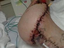 2months after acc. 2weeks after surgery