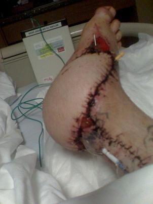 2months after acc. 2weeks after surgery