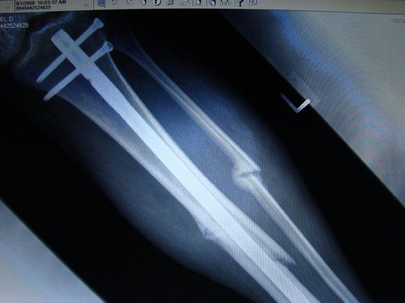 Tib-Fib_0801-2.jpg