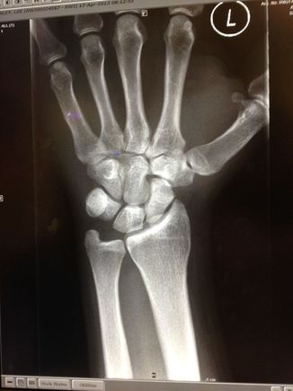 xray1